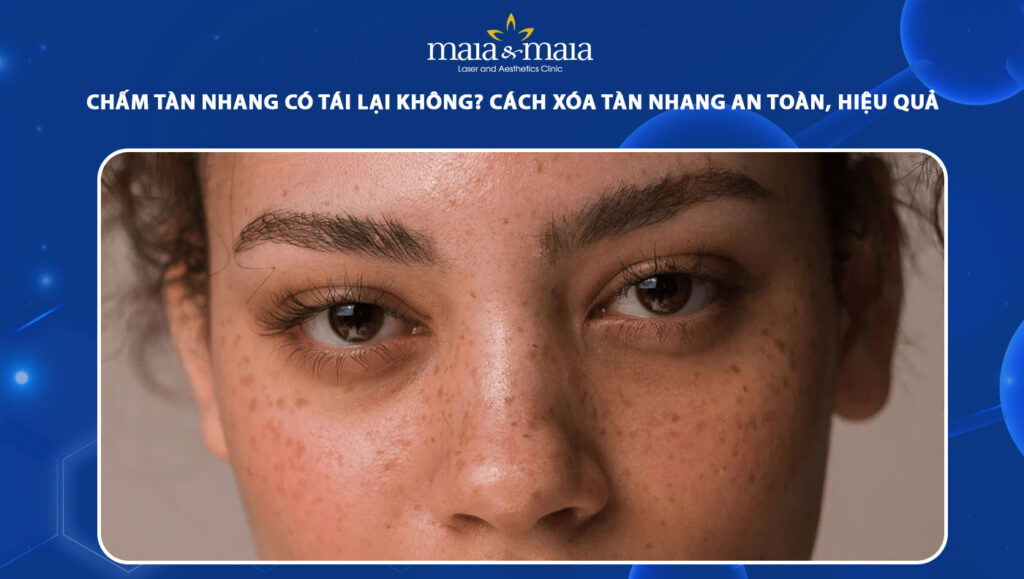 Chấm tàn nhang có tái lại không? Cách xóa tàn nhang dứt điểm 1 chấm tàn nhang