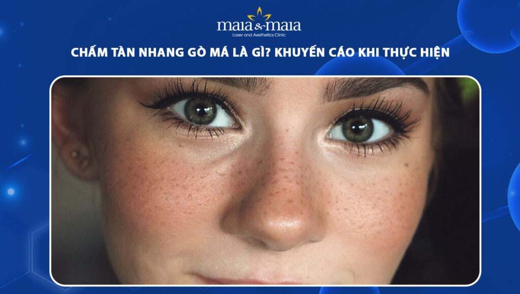 chấm tàn nhang gò má