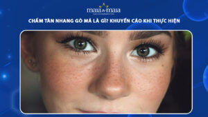 chấm tàn nhang gò má