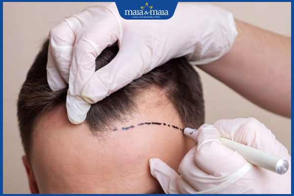 chuẩn bị hạ đường chân tóc