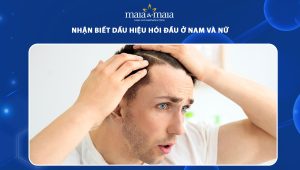 dấu hiệu hói đầu