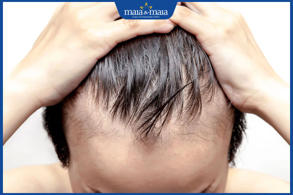 dấu hiệu hói đầu ở nam
