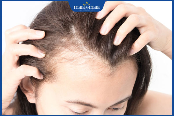 dấu hiệu hói đầu ở nữ