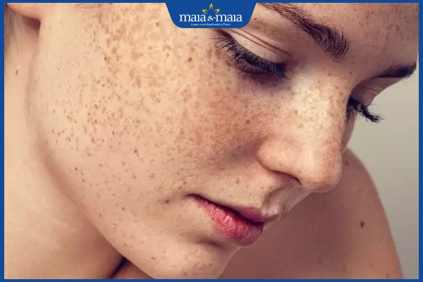 Da bị cháy nắng sạm đen do đâu? Cách phòng ngừa và cải thiện 3 dấu hiệu tàn nhang