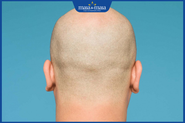 Các kiểu tóc cho người hói đầu lấy lại tự tin để xuống phố 3 đầu trọc