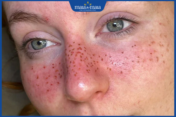 dị ứng xăm tàn nhang