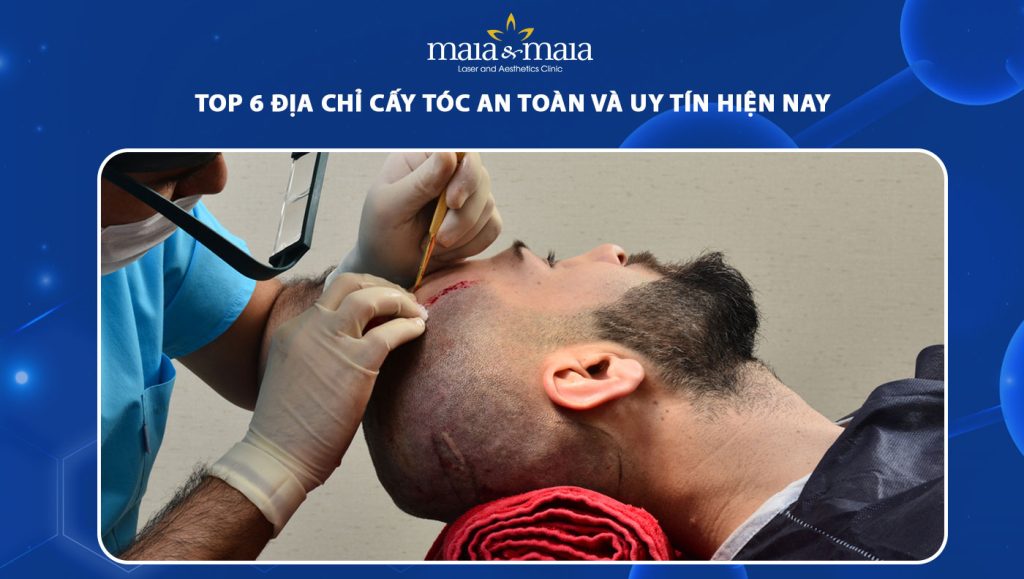 địa chỉ cấy tóc