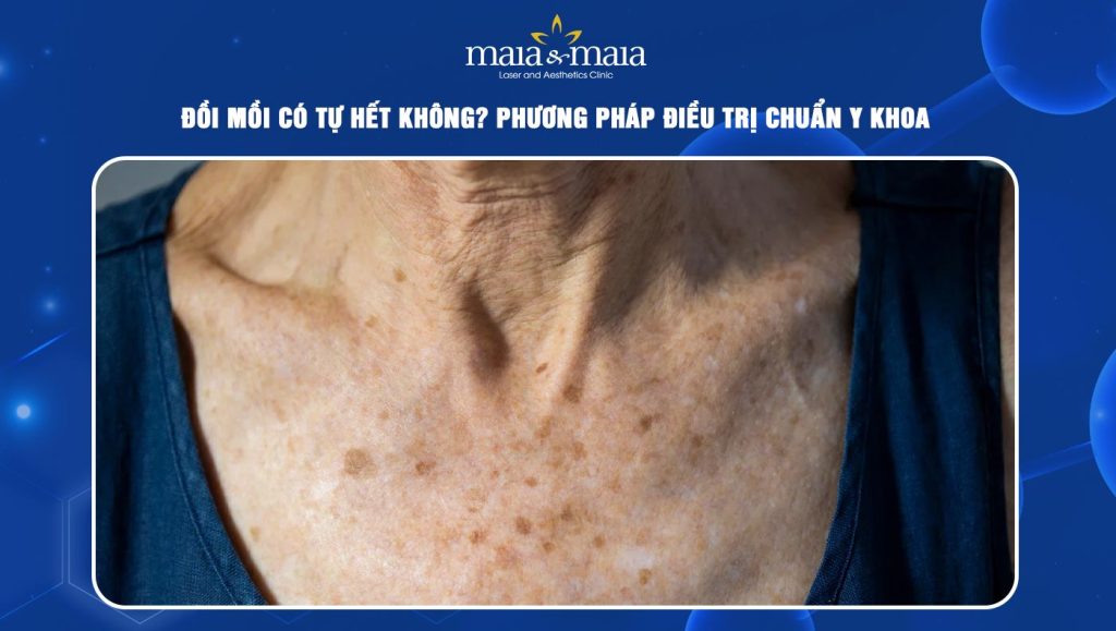 đồi mồi có tự hết không