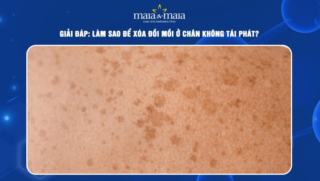 Giải đáp: Làm sao để xóa đồi mồi ở chân không tái phát? 1 đồi mồi ở chân