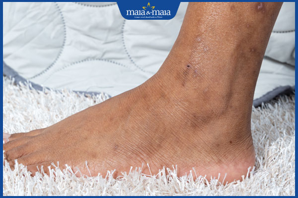 Giải đáp: Làm sao để xóa đồi mồi ở chân không tái phát? 2 đốm đồi mồi ở chân