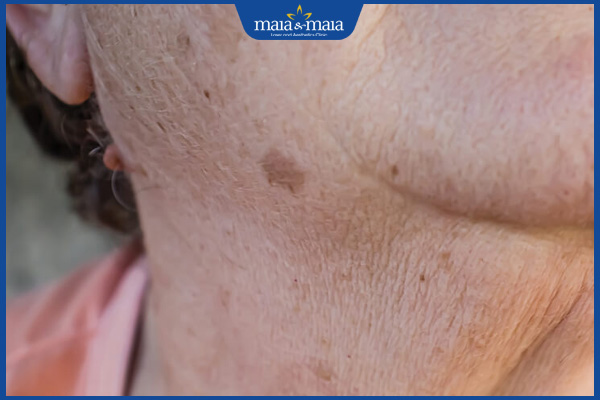 Đồi mồi ở cổ: Nguyên nhân và cách điều trị dứt điểm 2 đốm đồi mồi ở cổ