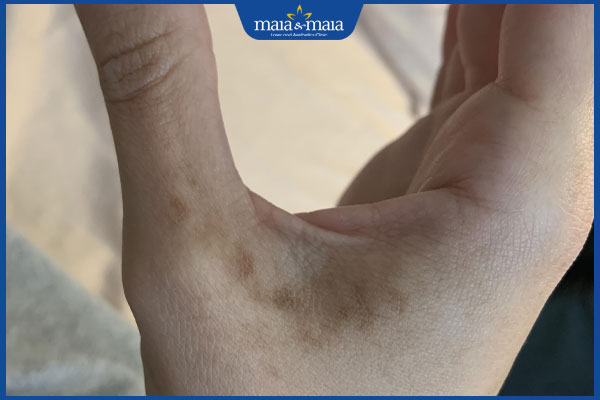 đốm nâu trên tay