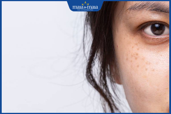 Chấm tàn nhang có tái lại không? Cách xóa tàn nhang dứt điểm 3 đốm tàn nhang nông