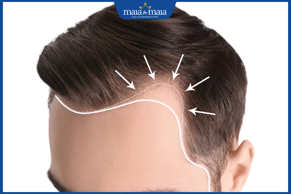 đường chân tóc