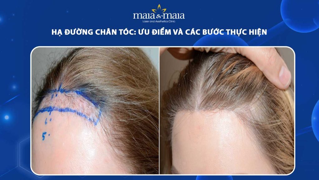 hạ đường chân tóc
