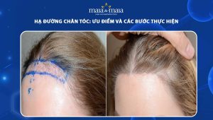 hạ đường chân tóc