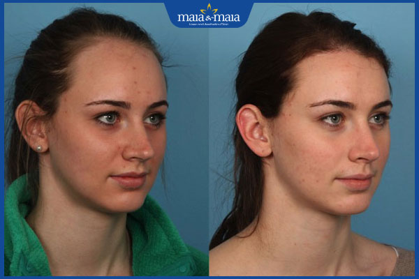 hạ đường chân tóc ở nữ