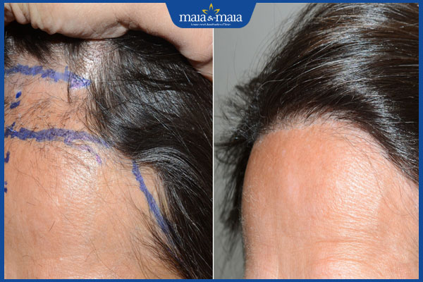 hiệu quả của hạ đường chân tóc