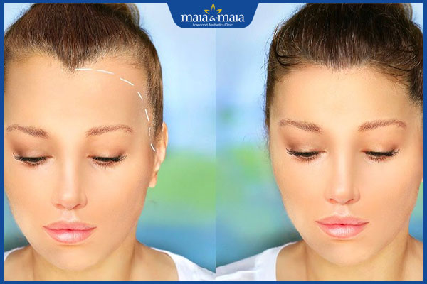 hiệu quả sau cấy tóc trán cao