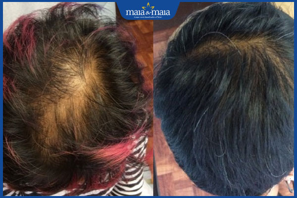 hiệu quả tăng sinh tế bào mầm tóc