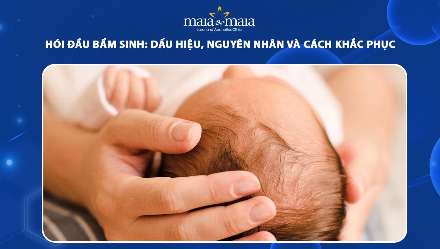 hói đầu bẩm sinh