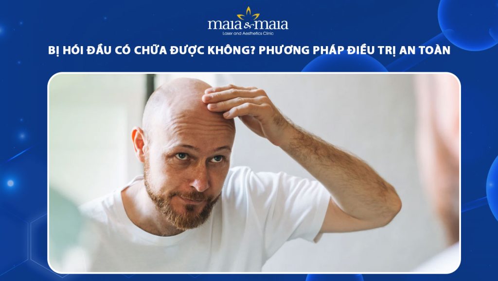 hói đầu có chữa được không
