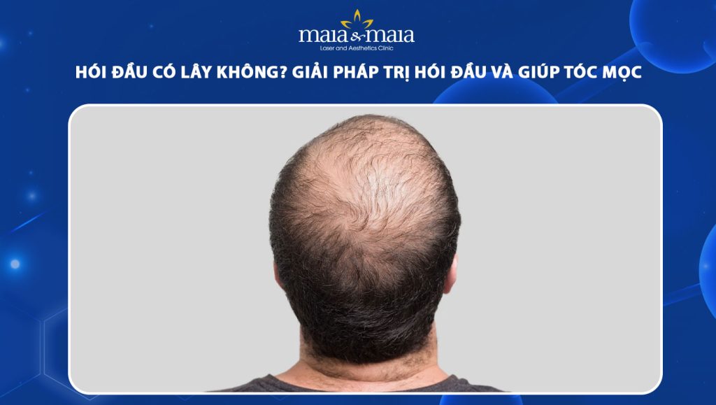 Hói đầu có lây không? Cách trị hói và giúp tóc mọc nhanh hơn 1 hói đầu có lây không