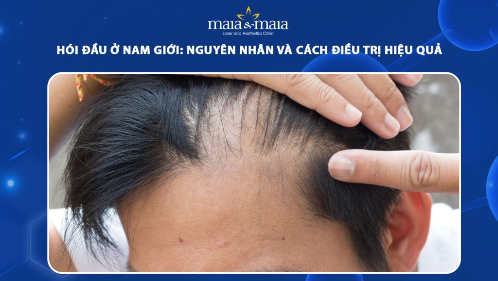 hói đầu ở nam giới