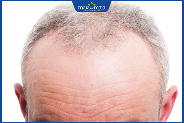 hói trán do tuổi tác