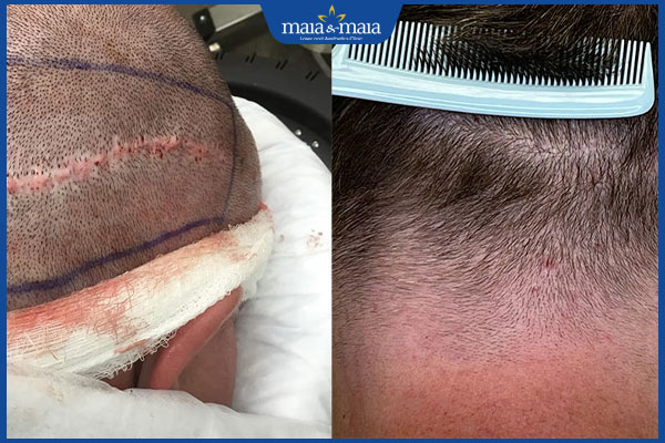 kết quả sau cấy tóc trên sẹo