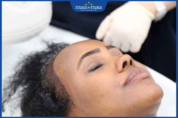 kết thúc cấy tóc