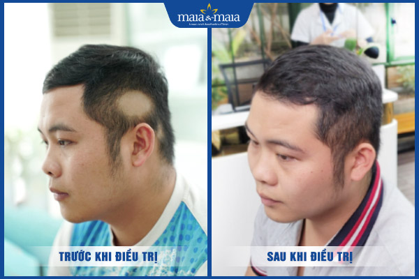 Khám phá TOP 10 dầu gội trị rụng tóc được ưa chuộng hiện nay 13 khách trị rụng tóc hói đầu