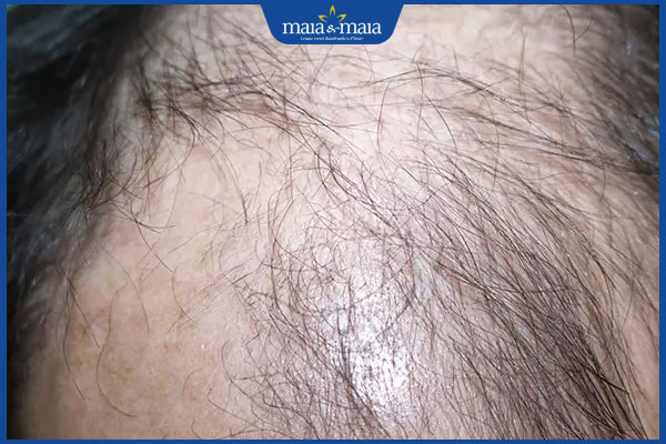 kiểu rụng tóc anagen