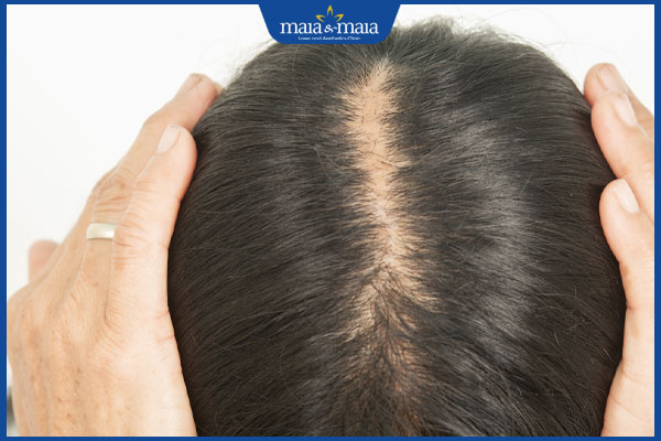 kiểu rụng tóc androgen