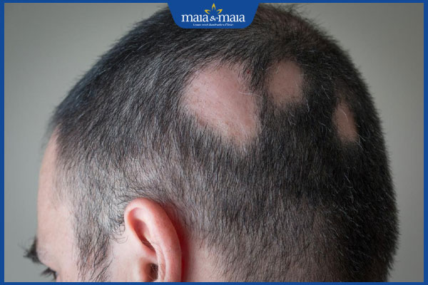 kiểu rụng tóc hình đồng xu