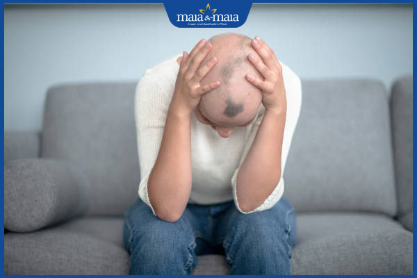 kiểu rụng tóc toàn thể