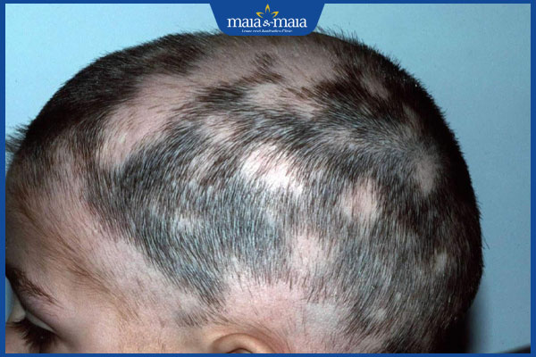 Rụng tóc kiểu rừng thưa là gì? Phương pháp điều trị hiệu quả 2 kiểu tóc rụng rừng thưa