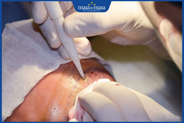 Cấy tóc FUE giá bao nhiêu? Lưu ý trước và sau khi thực hiện 2 kỹ thuật cấy tóc FUE