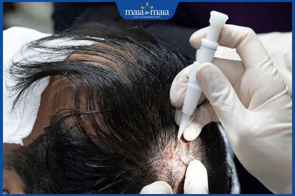 kỹ thuật cấy tóc HAT