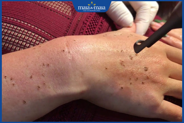 laser trị đồi mồi ở tay