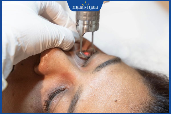 laser trị quầng thâm mắt