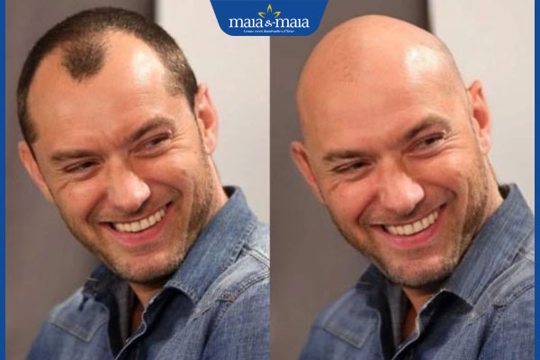 lợi ích của app làm hói đầu