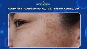 nám da hình thành ở độ tuổi nào