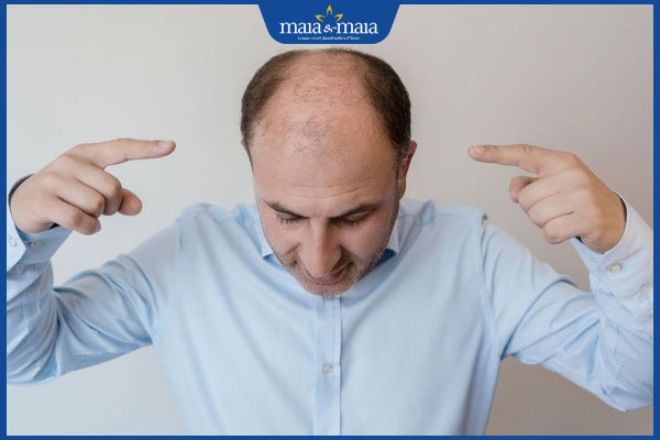 nam giới bị rụng tóc