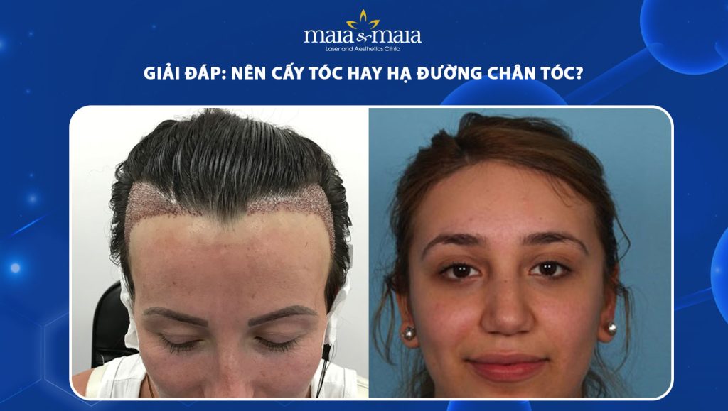 nên cấy tóc hay hạ đường chân tóc