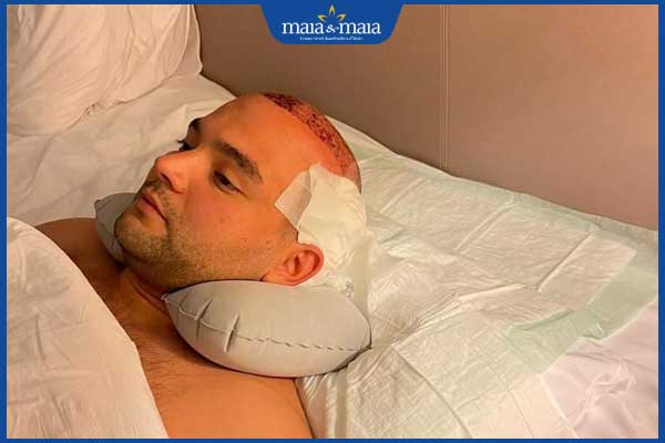 Cấy tóc bao lâu thì mọc lại? Cách chăm sóc để tóc nhanh mọc 3 nghỉ ngơi đúng cách sau cấy tóc