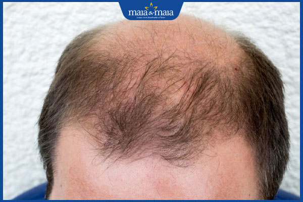 người lớn tuổi bị rụng tóc