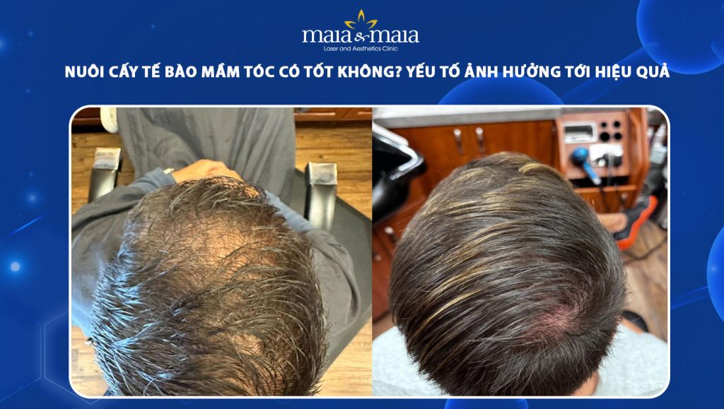 Nuôi cấy tế bào mầm tóc có hiệu quả không? Các yếu tố ảnh hưởng 1 nuôi cấy tế bào mầm tóc có hiệu quả không