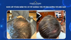 nuôi cấy tế bào mầm tóc có hiệu quả không