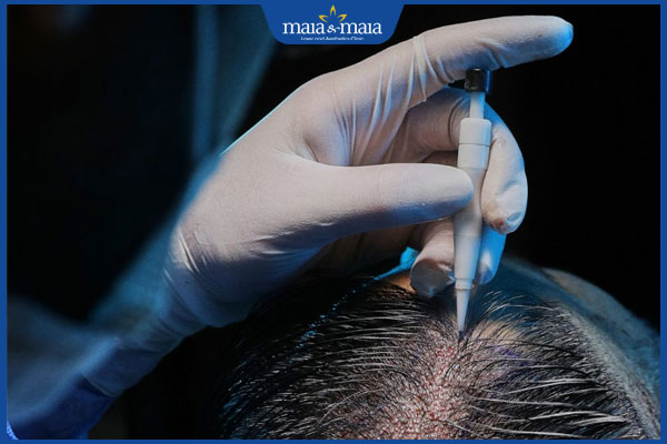 phương phap cấy tóc DHI